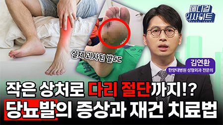 작은 상처로 다리 절단까지!? 당뇨발의 증상과 재건 치료법ㅣ메디컬 인사이트[90회]