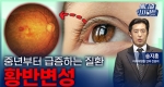 중년부터 급증하는 질환 황반변성ㅣ메디컬 인사이트[114회]