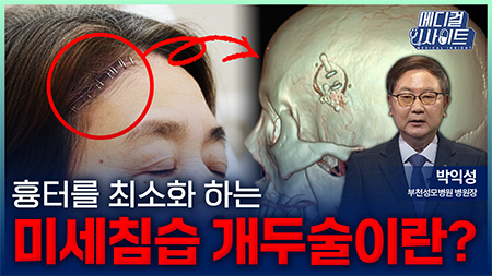 흉터를 최소화 하는 미세침습 개두술이란?ㅣ메디컬 인사이트[121회]