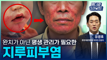 완치가 아닌 평생 관리가 필요한 지루피부염ㅣ메디컬 인사이트[125회]