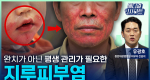 완치가 아닌 평생 관리가 필요한 지루피부염ㅣ메디컬 인사이트[125회]