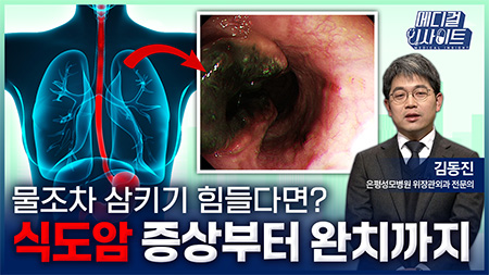 물조차 삼키기 힘들다면? 식도암 증상부터 완치까지ㅣ메디컬 인사이트[128회]
