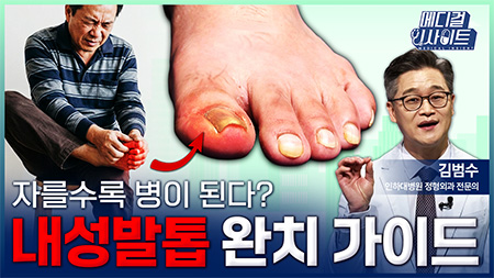 자를수록 병이 된다? 내성발톱 완치 가이드ㅣ메디컬 인사이트[129회]