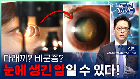 다래끼? 비문증? 눈에 생긴 암일 수 있다!ㅣ메디컬 인사이트[137회]