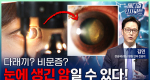 다래끼? 비문증? 눈에 생긴 암일 수 있다!ㅣ메디컬 인사이트[137회]