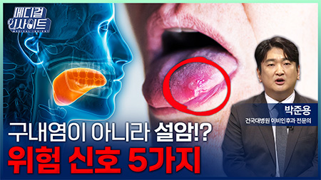 의사가 말하는 설암 위험 신호 5가지ㅣ메디컬 인사이트[143회]