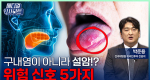 의사가 말하는 설암 위험 신호 5가지ㅣ메디컬 인사이트[143회]