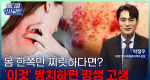 대상포진 후 신경통 막는 골든타임 72시간의 비밀ㅣ메디컬 인사이트[151회]
