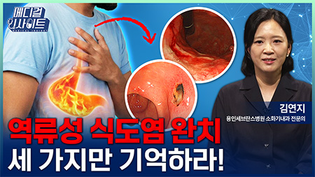참으면 병 되는 ‘역류성 식도염’ 완치법ㅣ메디컬 인사이트[158회]