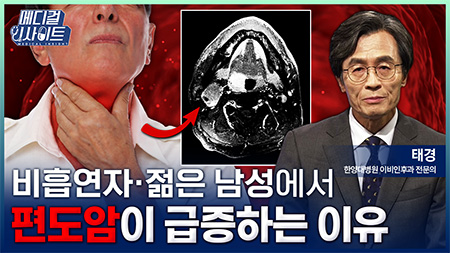20~30대 남성에서 급증하는 편도암의 충격적 원인ㅣ메디컬 인사이트[159회]
